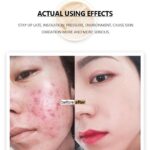 Acne Treatment Face Cream - Image 4